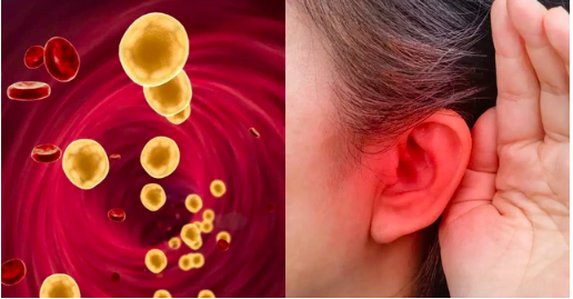Khi mỡ máu tăng cao, tai sẽ phát ra 3 “tín hiệu” cảnh báo đỏ